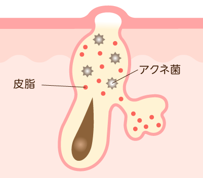 白ニキビ