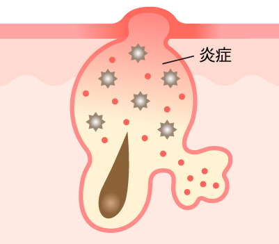 赤ニキビ
