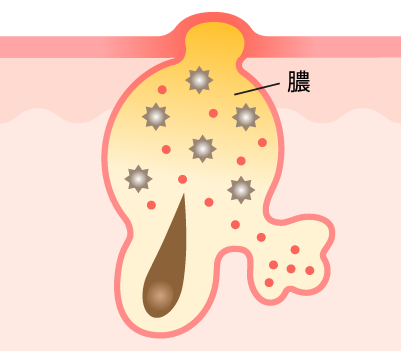 黄ニキビ