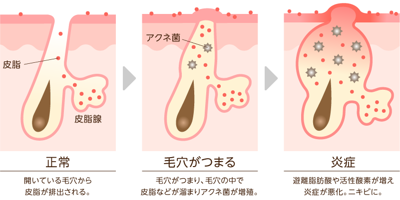 ニキビのでき方