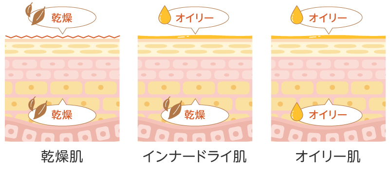 インナードライ